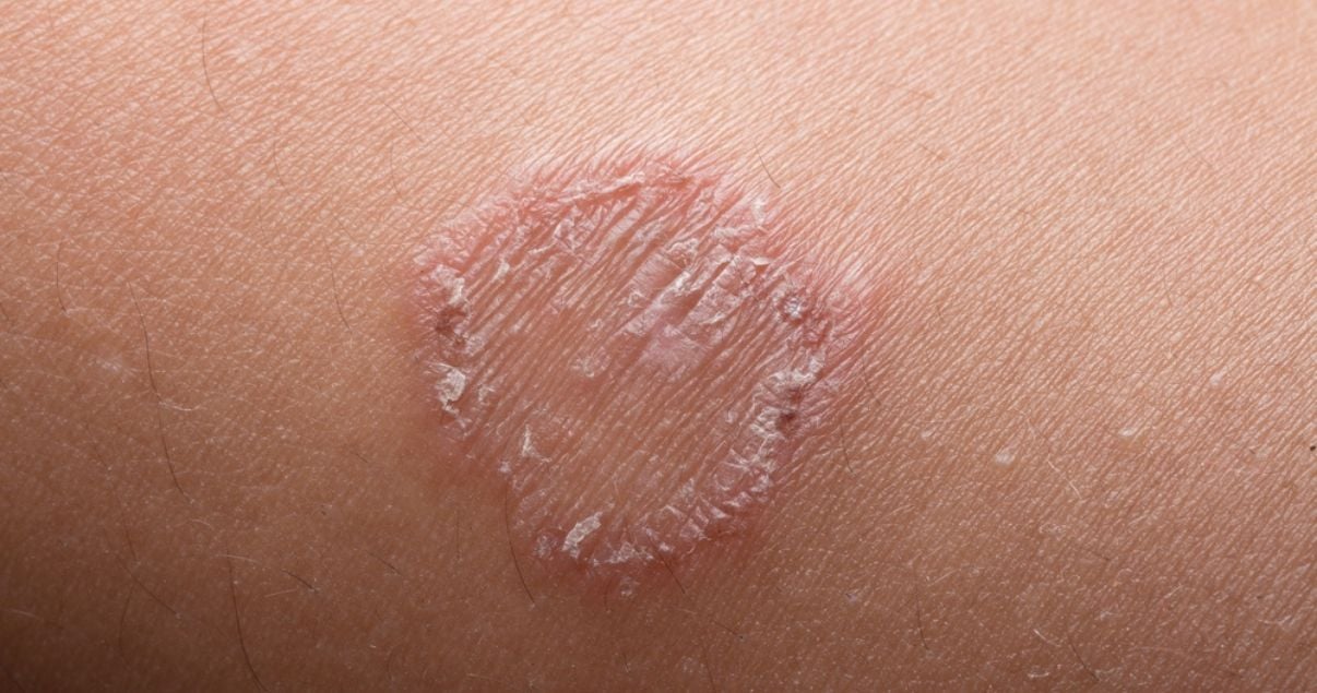 Ringworm on Tattoo: Is it Contagious? - wide 4
